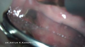 Извлечение винта абатмента из шахты имплантата с помощью ультразвука.