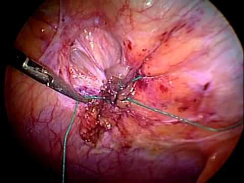 Laparoscopic IPOM (послеоперационная грыжа) смотреть онлайн