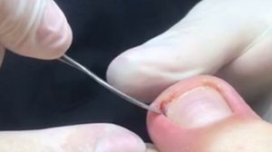 Вросший ноготь