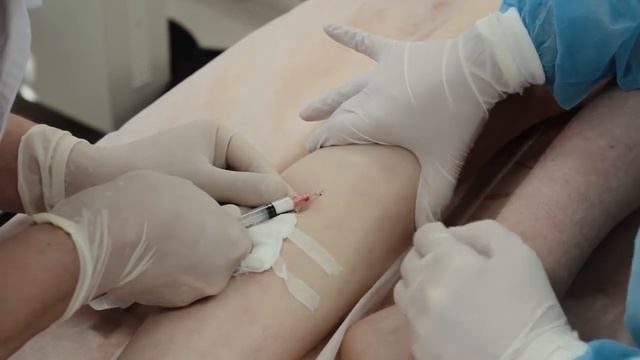 Пенная склеротерапия варикозных вен и микросклеротерапия сосудистых звездочек