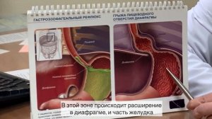 Грыжа пищеводного отверстия диафрагмы