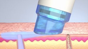 Косметологическая чистка лица HydraFacial MD