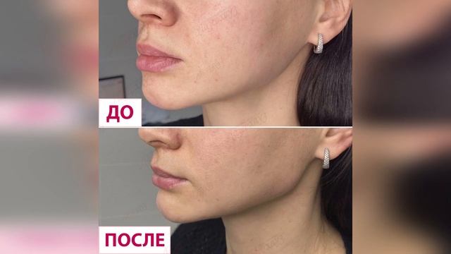 Результаты коррекции овала лица смотреть онлайн