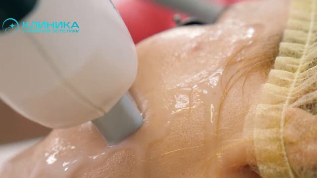 AFT-омоложение смотреть онлайн