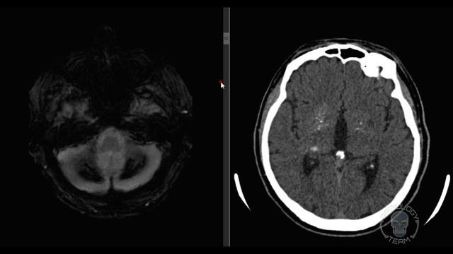 БОЛЕЗНЬ VS СИНДРОМ ФАРА / НАТАЛЬЯ МЕДВЕДЕВА /MOSCOW RADIOLOGY TEAM смотреть онлайн