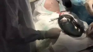 Троакарная цистостомия у пациента с нейрогенным мочевым пузырем после ОНМК