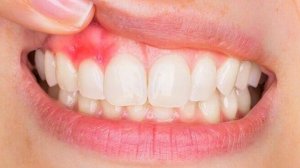 Попробуйте начать день с 1 стакана отвара с гвоздикой – и результат вас приятно удивит. Гвоздика...