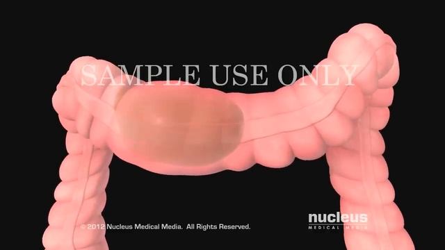 Irritable Bowel Syndrome | IBS смотреть онлайн