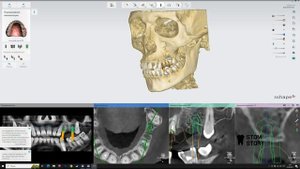 Изготовление хирургического шаблона Exo Cad + 3Shape
