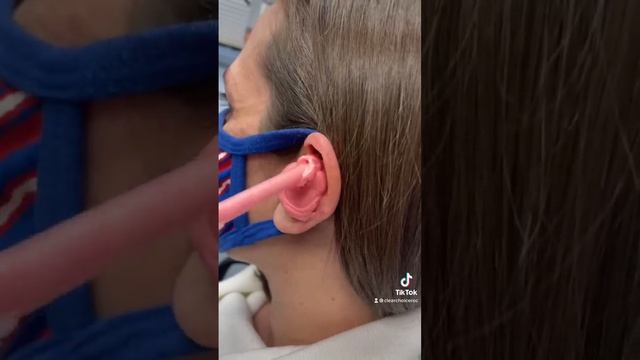 #billsmafia for the win ? #earimpression #satisfying #earwax #audiologist #audiology #earwaxremoval