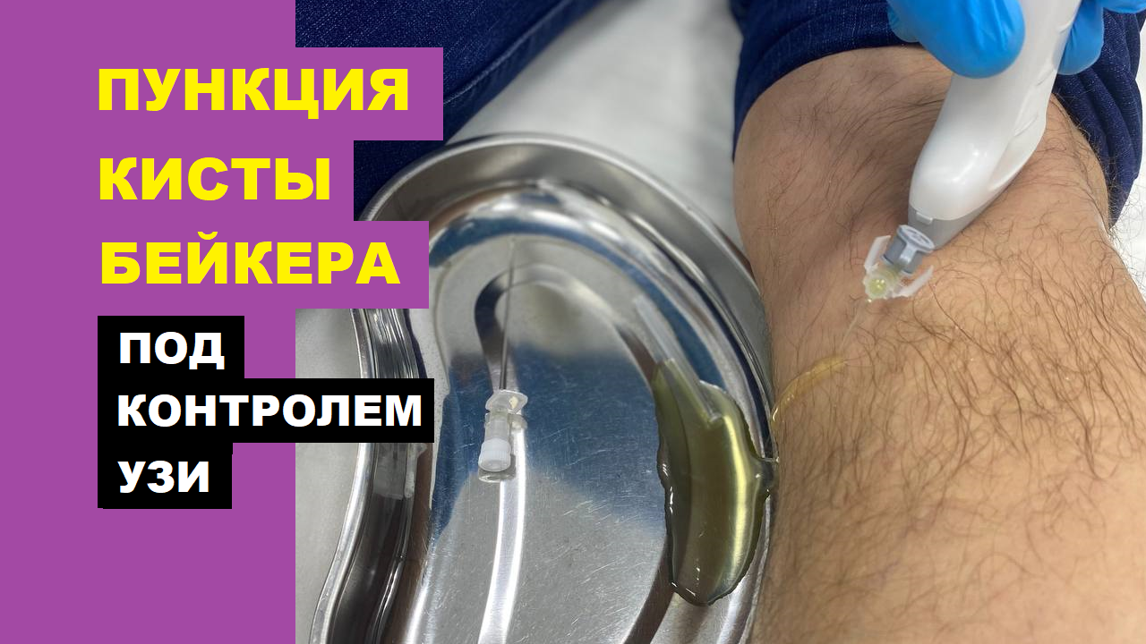 Пункция кисты БЕЙКЕРА под контролем УЗИ