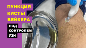 Пункция кисты БЕЙКЕРА под контролем УЗИ