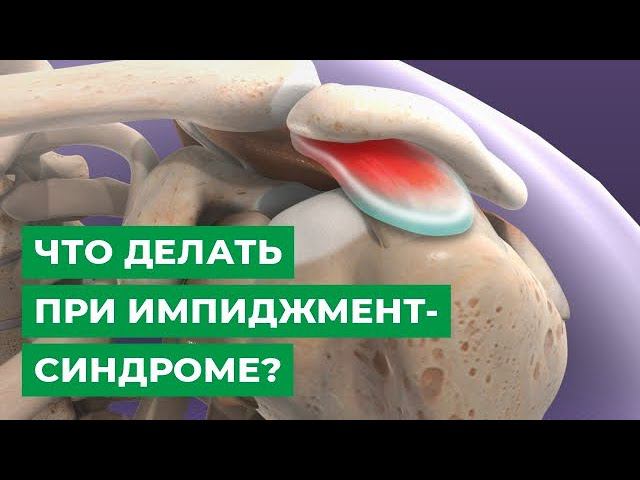 Импинджмент сухожилия надостной мышцы. Импинджмент синдром плечевого сустава. Синдром вращающей манжеты плеча. Синдром плечевой манжеты. Импиджмент синдром тазобедренный сустав.