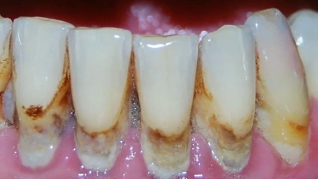 Как лечить неприятные запаха изо рта? смотреть онлайн