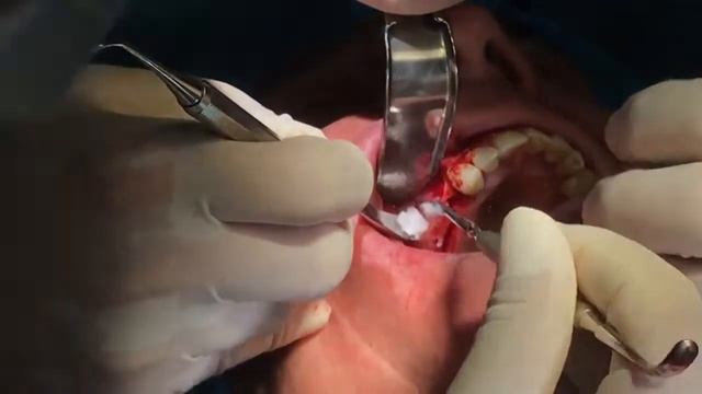 Sinus lifting ,collagen membrane and 2 OssStem placement смотреть онлайн