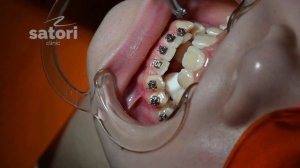 Фиксация брекетов при дистопии клыка и скученности. Самолигирующие брекеты.