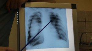Рак лёгких рентген lung cancer