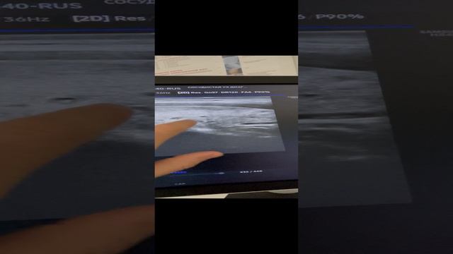 Узелки в щитовидной железе. Обследование сосудов. Узи сосудов. Флеболог Москва. Флеболог. Хирург . смотреть онлайн