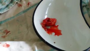 Open Prostatectomy/Как выглядит аденома простаты?