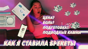 Мой опыт установки брекетов?