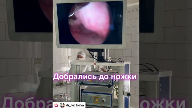 HRS Polypectomy. Полипэктомия.
