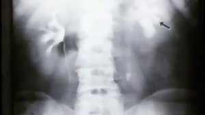 Экскреторная урография