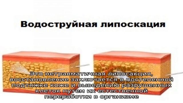 Правила реабилитации после липосакции