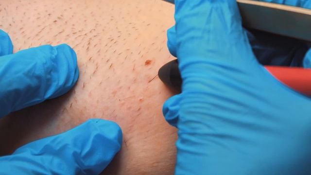 Процедура Электроэпиляция. Студия LYSENKO