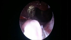 Полип матки ES полипэктомия в Испании