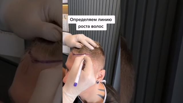 Пересадка волос в Турции #пересадкаволос #пересадкаволосвтурции