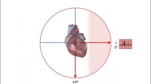 Working out the QRS axis on an ECG