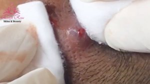 Acne Pustules BIG Removal for MAN | Acne Treatment (#32)
