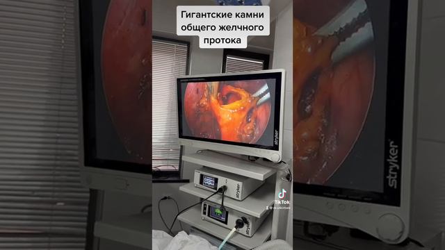 Лапароскопическое удаление камней из желчного протока. #холецистит #камнивжелчном #эндоскопия смотреть онлайн
