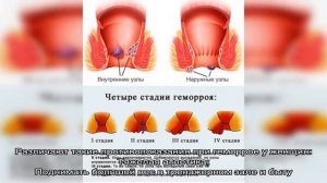 Чего нельзя делать при геморрое
