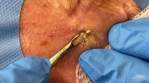 Extremely Clogged Pores Extracted | Contour Dermatology