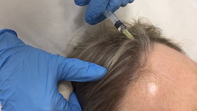 Мезотерапия волосистой части головы (мезотерапия волос) в МЦ Корона смотреть онлайн