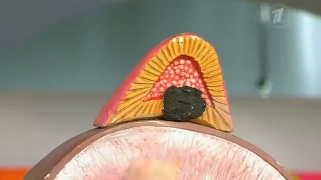 Как женщине избавиться от лишних волос. Нет усам и бороде!