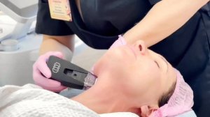 МИКРОИГОЛЬЧАТЫЙ Rf-лифтинг МОРФЕУС