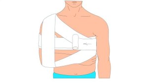 Наложение повязки при переломе ключицы