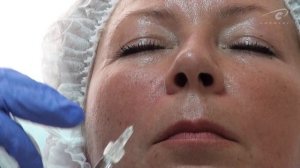 Коррекция носогубной складки Princess Filler