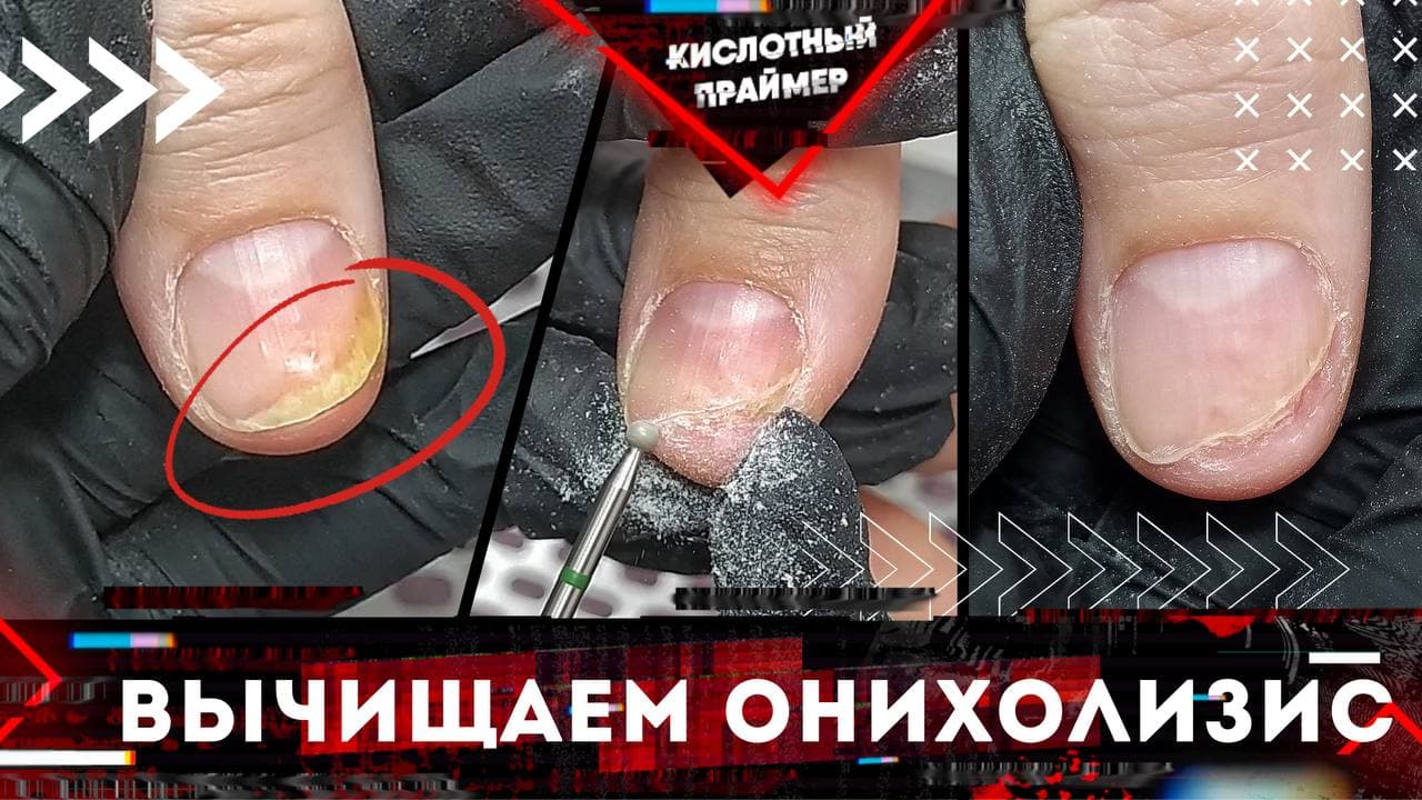 Снова онихолизис ногтей??? Отслоение ногтя? Подробно! Белые пятна на ногтях, зачищаем!
