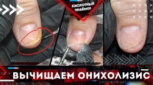 Снова онихолизис ногтей??? Отслоение ногтя? Подробно! Белые пятна на ногтях, зачищаем!