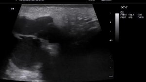 Срединная киста шеи