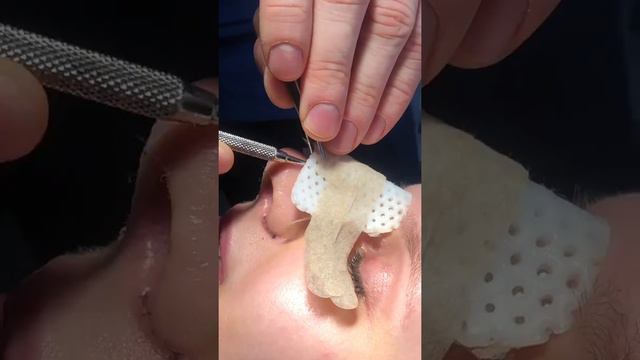 Ринопластика | Рождение идеального носа смотреть онлайн