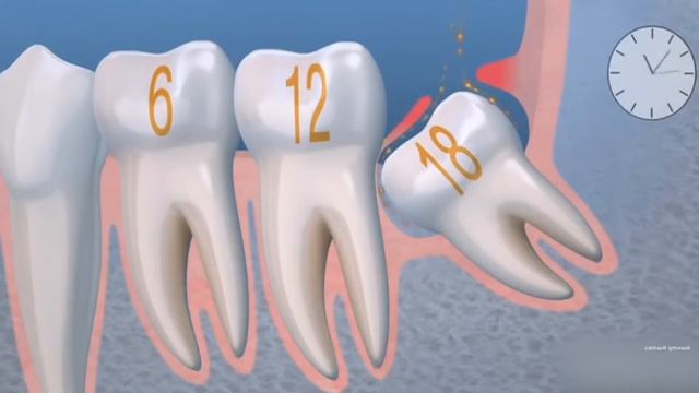 Что будет, если не удалять зуб мудрости? смотреть онлайн