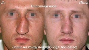 Пластика носа. Ринопластика фото. Пластическая хирургия доктора Олашина