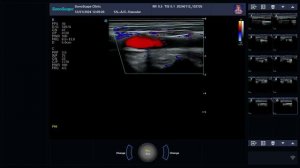 Как измерить СТЕНОЗ сонной артерии на УЗИ?