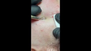 КАК ПОЯВЛЯЮТСЯ КОМЕДОНЫ. Чистка Пор Лица.