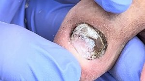 Severe onychomycosis, very thick nails cut off layer by layer【Doctor Liu Pedicure】