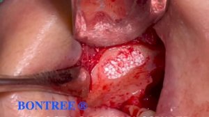 Maxillary sinus opening using magnetic drill